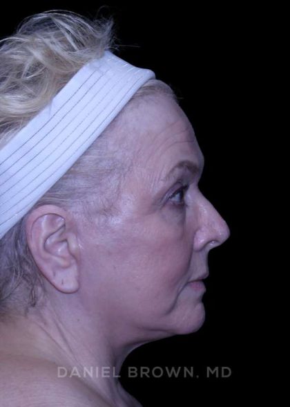 Facelift Before & After Patient #9836