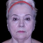 Facelift Before & After Patient #9836