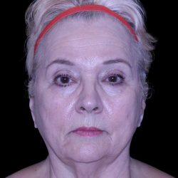 Facelift Before & After Patient #9836