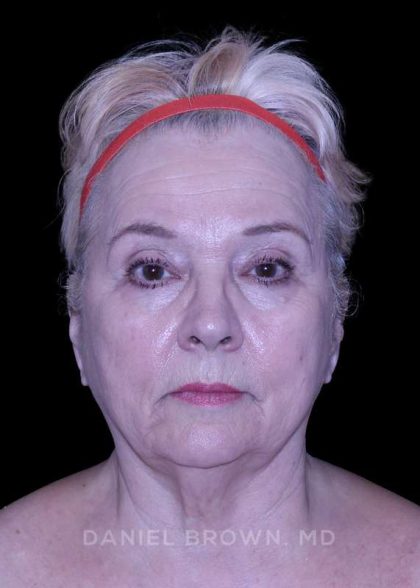 Facelift Before & After Patient #9836