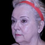 Facelift Before & After Patient #9836