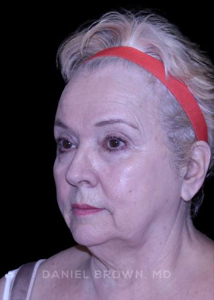 Facelift Before & After Patient #9836