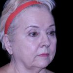Facelift Before & After Patient #9836