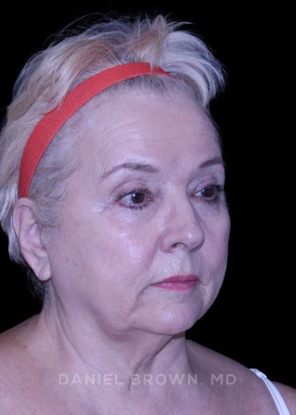 Facelift Before & After Patient #9836