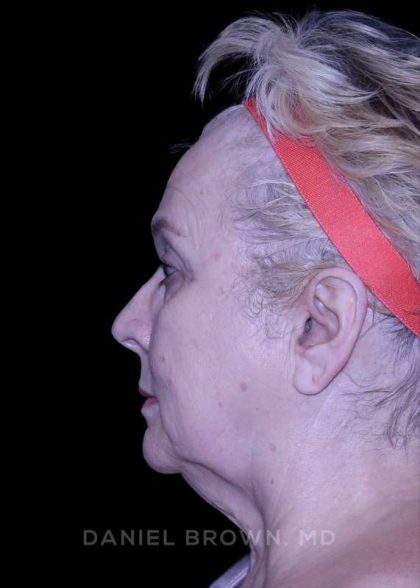 Facelift Before & After Patient #9836