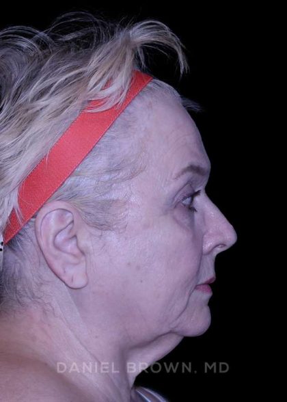 Facelift Before & After Patient #9836