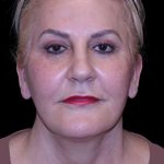 Facelift Before & After Patient #9847