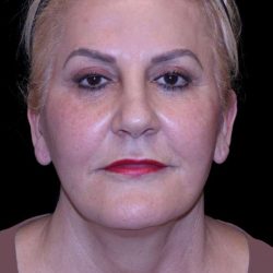 Facelift Before & After Patient #9847