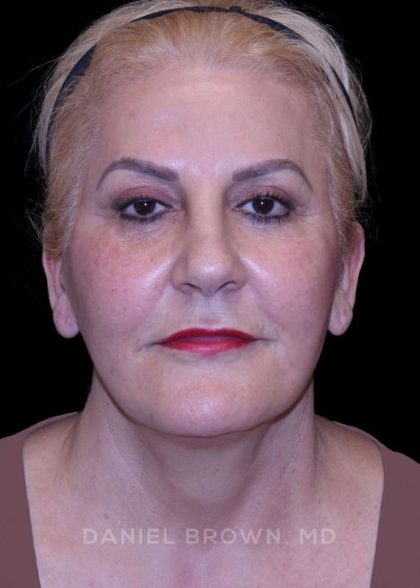 Facelift Before & After Patient #9847