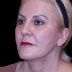 Facelift Before & After Patient #9847