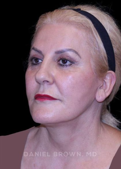 Facelift Before & After Patient #9847