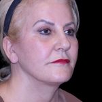 Facelift Before & After Patient #9847