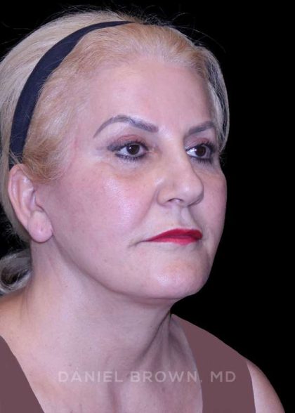 Facelift Before & After Patient #9847
