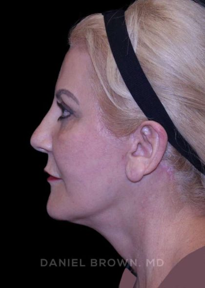 Facelift Before & After Patient #9847