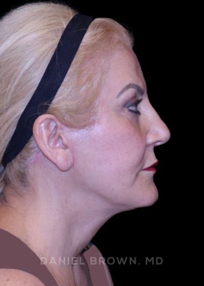 Facelift Before & After Patient #9847