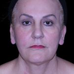 Facelift Before & After Patient #9847