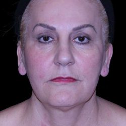 Facelift Before & After Patient #9847