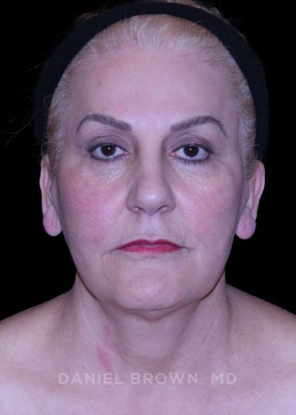Facelift Before & After Patient #9847