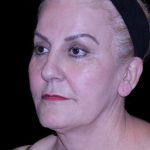 Facelift Before & After Patient #9847