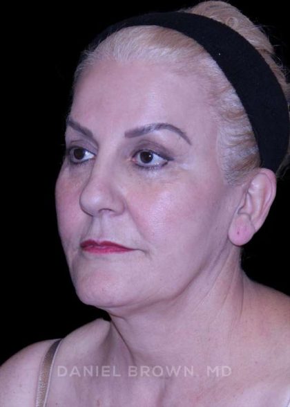 Facelift Before & After Patient #9847