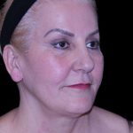 Facelift Before & After Patient #9847