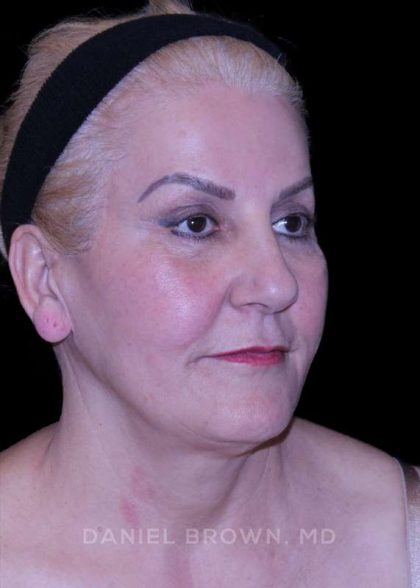 Facelift Before & After Patient #9847