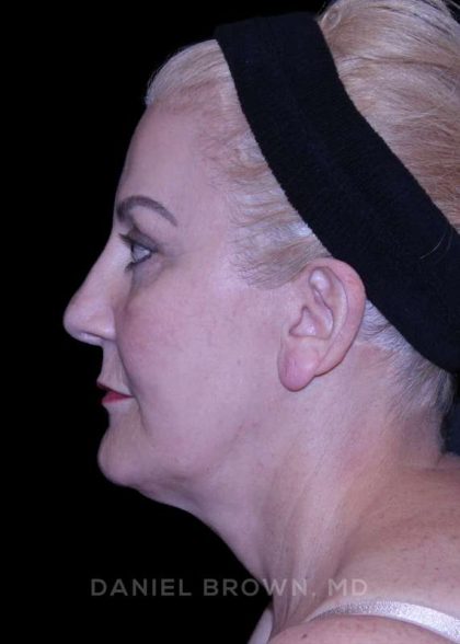 Facelift Before & After Patient #9847