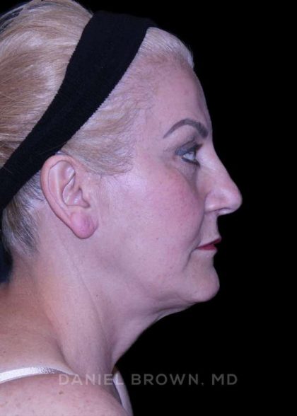 Facelift Before & After Patient #9847