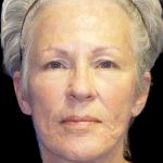 Facelift Before & After Patient #9854