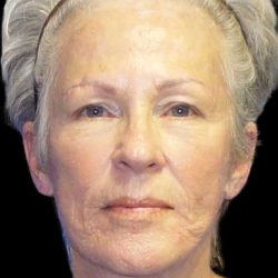 Facelift Before & After Patient #9854