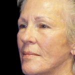 Facelift Before & After Patient #9854