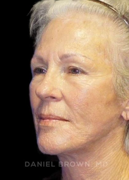 Facelift Before & After Patient #9854