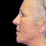 Facelift Before & After Patient #9854