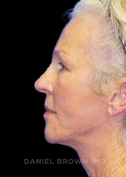 Facelift Before & After Patient #9854