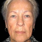 Facelift Before & After Patient #9854