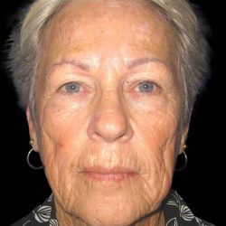 Facelift Before & After Patient #9854
