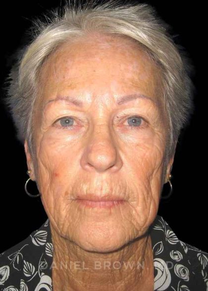 Facelift Before & After Patient #9854