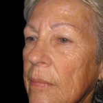 Facelift Before & After Patient #9854