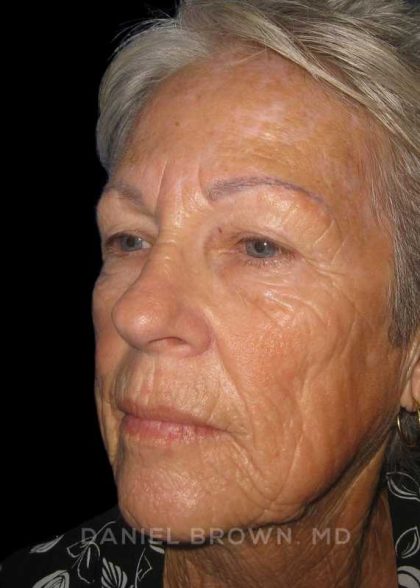 Facelift Before & After Patient #9854