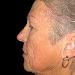 Facelift Before & After Patient #9854