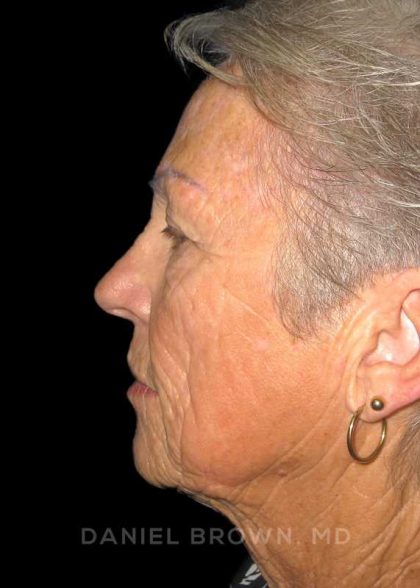 Facelift Before & After Patient #9854