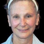Facelift Before & After Patient #9865