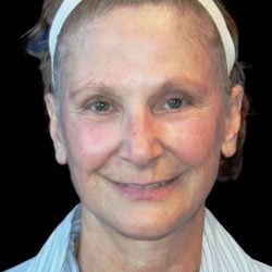 Facelift Before & After Patient #9865