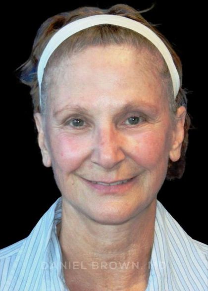 Facelift Before & After Patient #9865