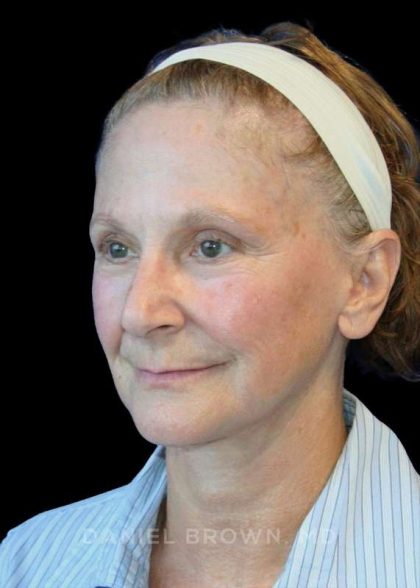 Facelift Before & After Patient #9865