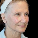 Facelift Before & After Patient #9865