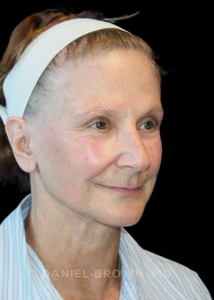 Facelift Before & After Patient #9865