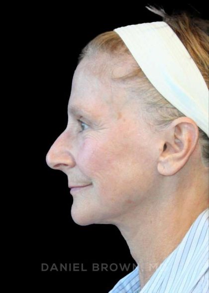 Facelift Before & After Patient #9865