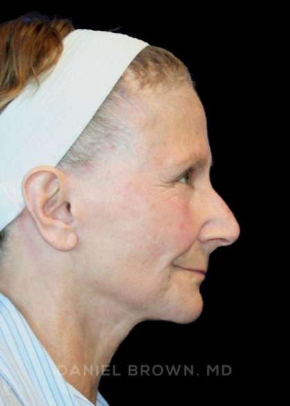 Facelift Before & After Patient #9865
