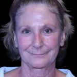 Facelift Before & After Patient #9865
